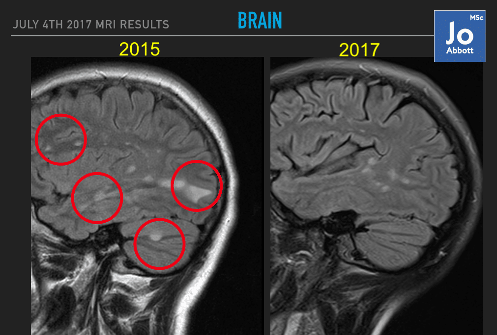 abbott_MRI_brain_MS