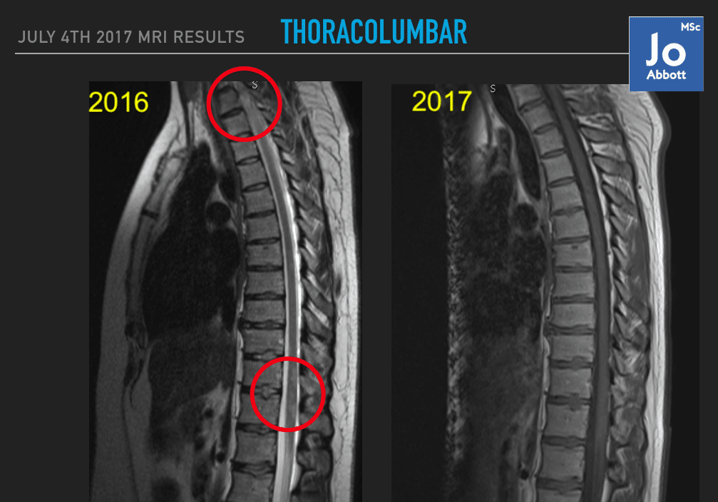 Wife's MRI of spinal cord
